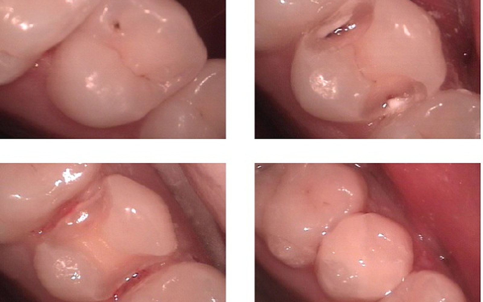Illustrazione di una otturazione dentale in composito