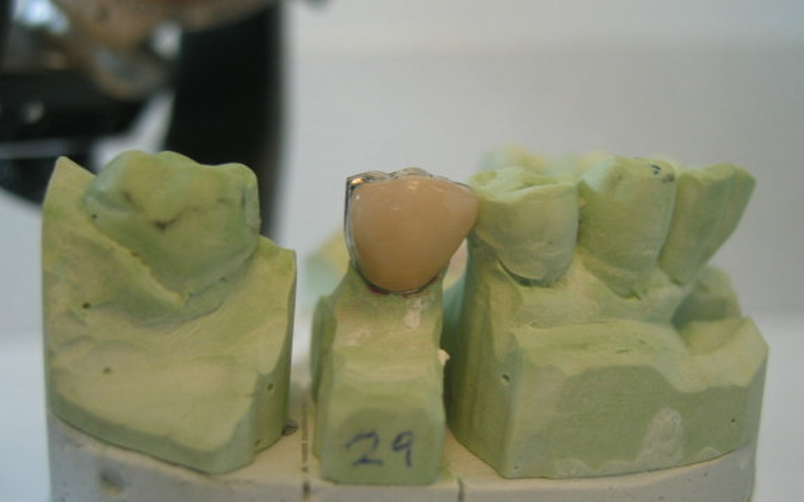 Illustrazione di corone dentali in ceramica